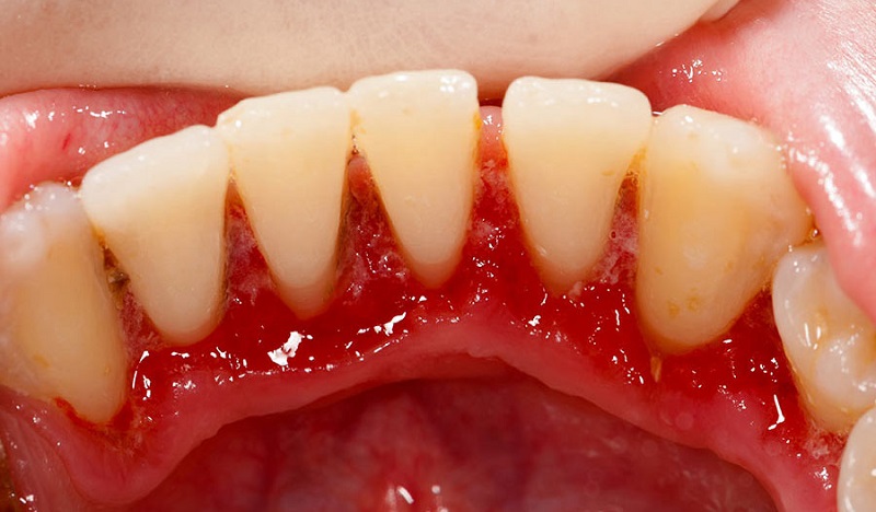 Vệ sinh răng miệng kém là nguyên nhân phổ biến dẫn tới viêm nướu