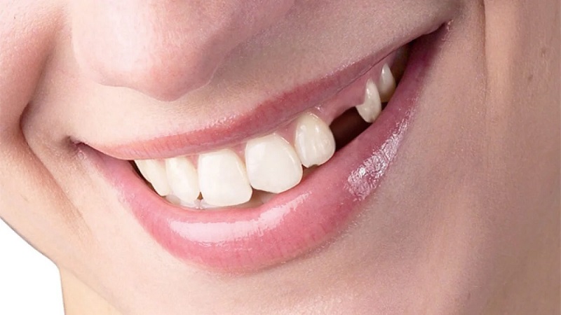 Bệnh lý viêm nhiễm có thể gây rụng răng