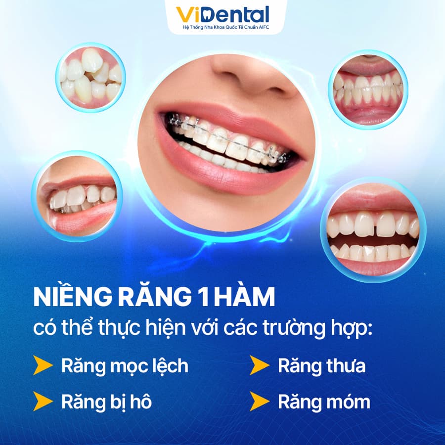 Niềng răng 1 hàm hoàn toàn có thể thực hiện với một số trường hợp răng bị sai lệch nhẹ