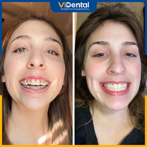Hình ảnh thực tế sự khác nhau giữa trước và sau khi niềng răng