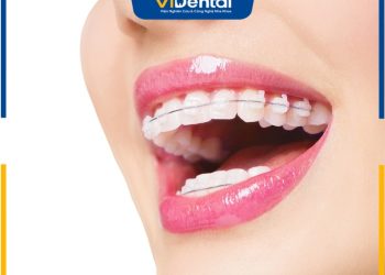 Review niềng răng mắc cài kim loại tốt không? Địa chỉ niềng răng uy tín