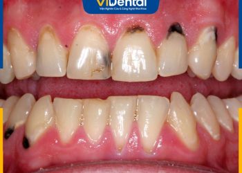 Bọc Răng Cửa Bị Sâu: Ưu - Nhược Điểm Và Quy Trình Thực Hiện