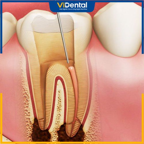 Viêm tủy răng là một hệ quả bọc răng sứ đáng lưu ý