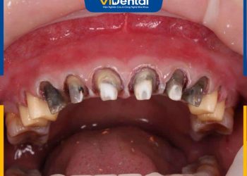[Cảnh Báo] 10 Hệ Quả Bọc Răng Sứ Không Đảm Bảo Chất Lượng