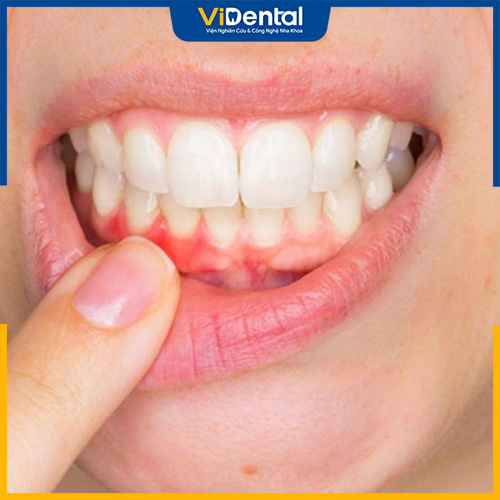 Răng bọc sứ bị sưng nướu là hiện tượng khá nhiều khách hàng gặp phải