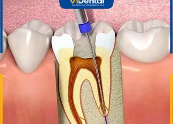 Bác Sĩ Giải Đáp: Răng Lấy Tủy Tồn Tại Được Bao Lâu Thì Hư?