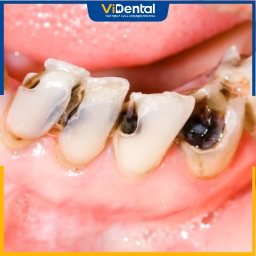Răng bọc sứ bị viêm tủy do sâu răng không được giải quyết triệt để