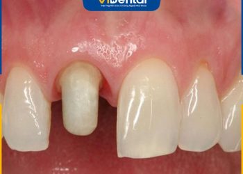 Răng Bọc Sứ Bị Viêm Tủy Do Đâu Và Cách Khắc Phục