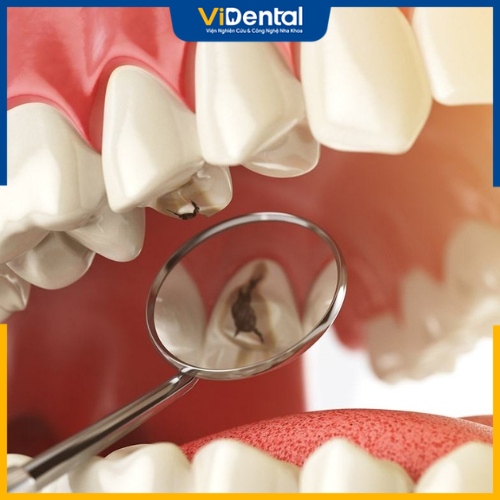 Quy trình trám răng gồm 4 bước được bác sĩ thực hiện đơn giản