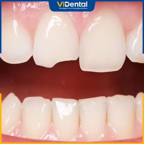 Trám răng được thực hiện với những trường hợp có răng bị sứt mẻ