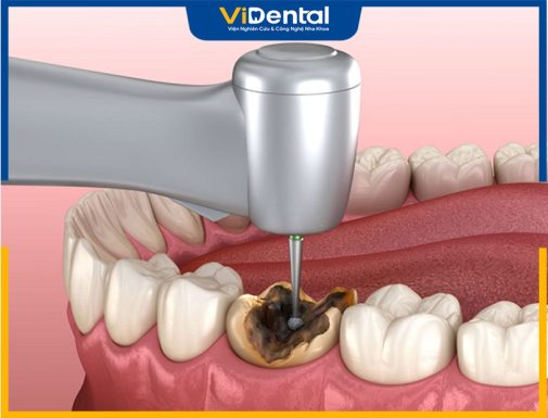 Có Nên Trám Răng Sâu Lỗ To Không? Kỹ Thuật Và Bảng Giá Mới Nhất