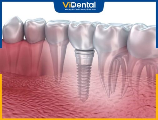 Tổng Hợp 11 Địa Chỉ Trồng Răng Implant Uy Tín TPHCM
