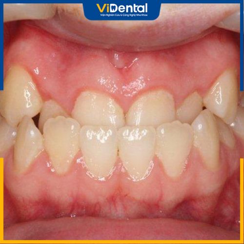 Khớp cắn ngược là thuật ngữ chỉ sự sai lệch tương quan giữa hai hàm răng