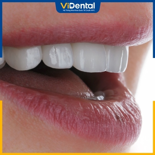 Răng sứ Cercon mang lại hiệu quả thẩm mỹ tương đối tốt