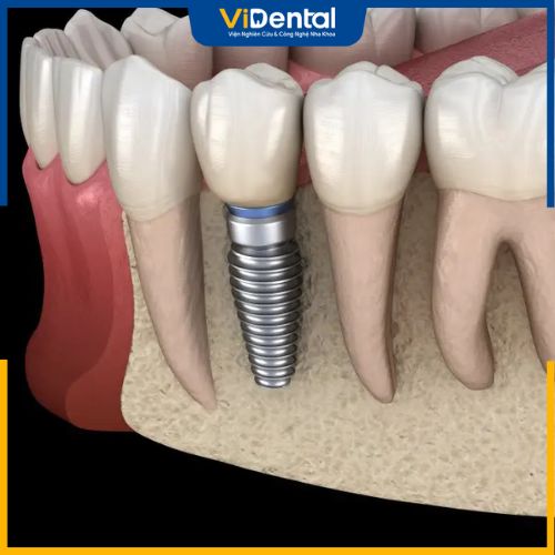 Trụ Implant Mỹ giúp hoàn thiện chức năng của răng 