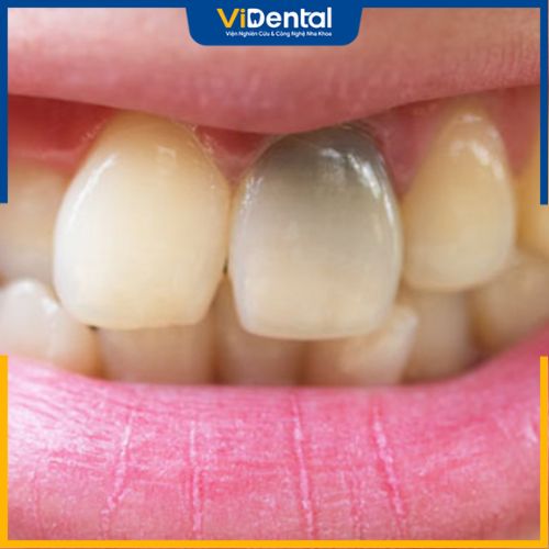 Nhận biết dấu hiệu bị viêm tủy răng