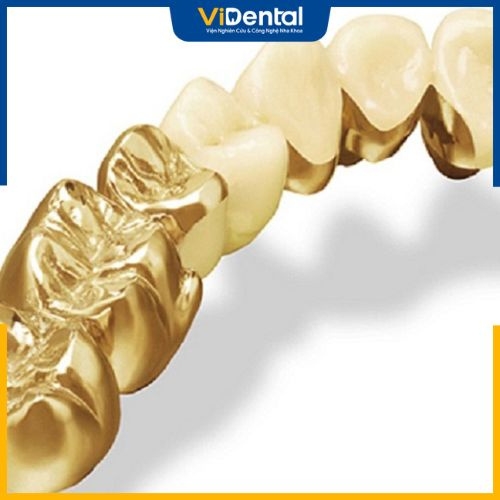 Răng vàng được đánh giá cao bởi khả năng chịu lực và chống oxy hóa trong môi trường khoang miệng