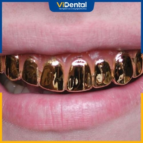 Răng bọc vàng trở thành trào lưu được giới trẻ quan tâm những năm gần đây 