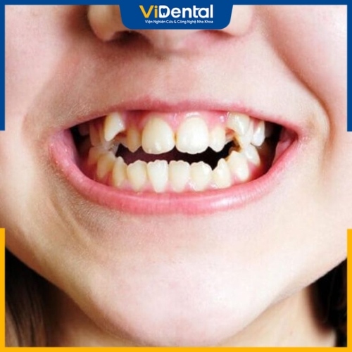 Răng khểnh là tình trạng răng mọc lệch khỏi vị trí trên cung hàm