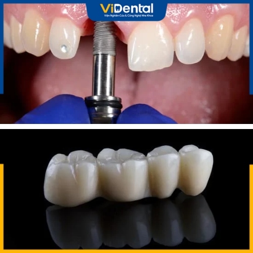 Phân tích sự khác nhau giữa cầu răng sứ và Implant