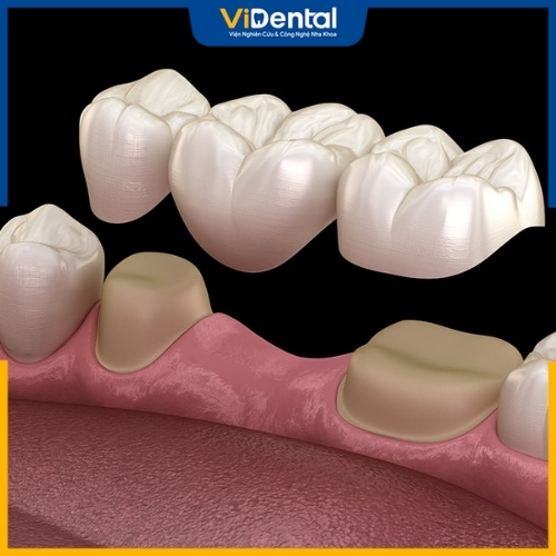 Cần mài nhỏ hai răng liền kề vị trí răng đã mất để làm trụ lắp cầu răng sứ