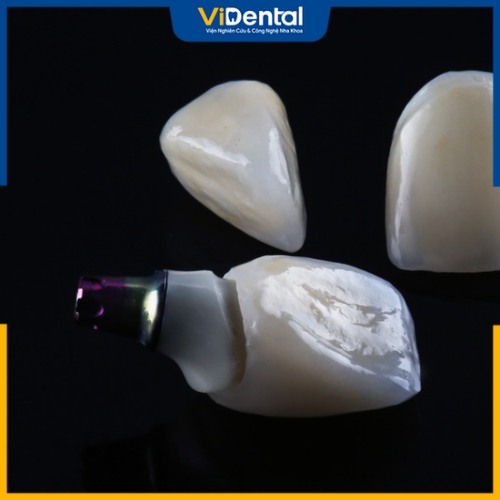 Cầu răng sứ và Implant loại nào có độ bền lâu hơn?