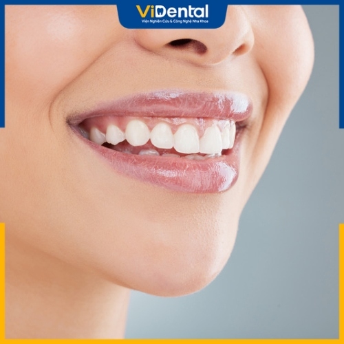 Nên niềng răng hay bọc sứ tùy thuộc vào tình trạng răng miệng cụ thể