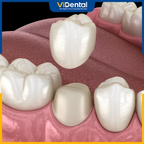 Chi phí thực hiện bọc răng sứ phụ thuộc vào chất liệu làm răng