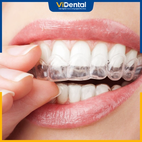 Phương pháp niềng răng này cần thời gian từ 1 - 2 năm
