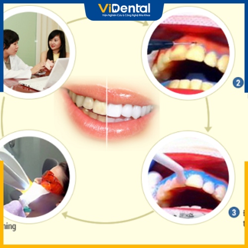 Quy trình tẩy trắng răng giúp khắc phục khuyết điểm về màu răng