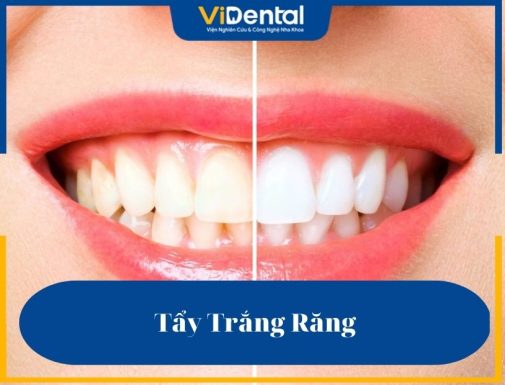 Quy trình tẩy trắng răng được nhiều khách hàng quan tâm