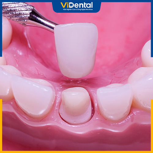 Răng Cercon Ht có khả năng bảo tồn răng thật tối đa, hạn chế các biến chứng xấu 