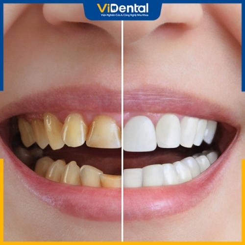 Răng sứ Cercon HT được đánh giá cao trong điều trị bọc răng sứ