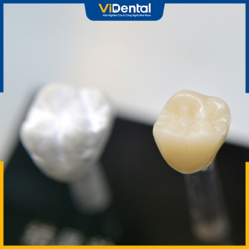 Răng sứ kim loại và răng toàn sứ có tuổi thọ sử dụng không giống nhau