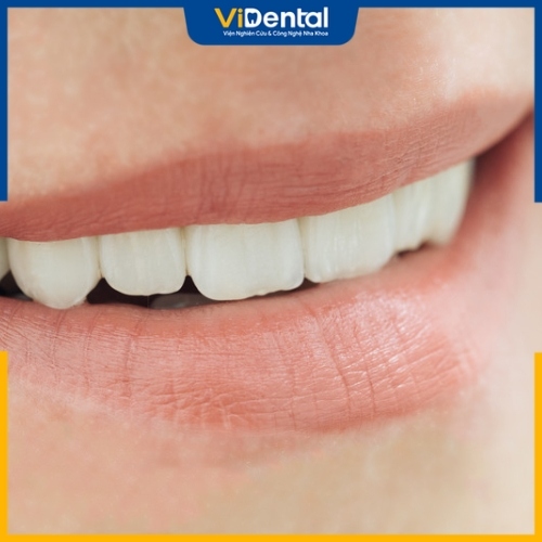 Răng sứ kim loại có thể bị suy giảm hiệu quả điều trị theo thời gian do bị oxy hóa