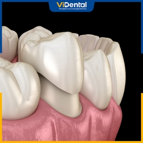 Lựa chọn răng sứ phù hợp mang tới hiệu quả với từng trường hợp điều trị khác nhau
