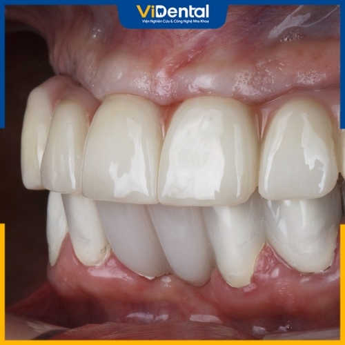 Hai thương hiệu răng sứ đều có độ bền bỉ cao và khả năng chịu lực tốt