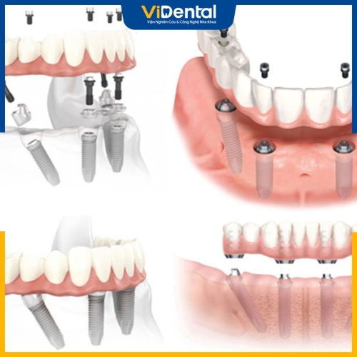 Trụ Implant Dentium có thể áp dụng trồng răng toàn hàm