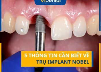 5 Thông TIn Cần Biết Về Trụ Implant Nobel
