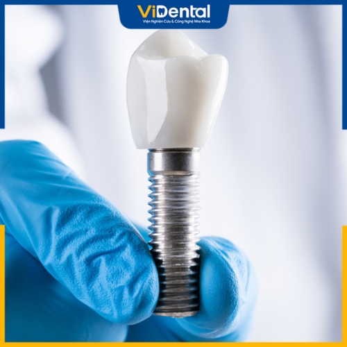 Trụ Implant Neodent được nhiều chuyên gia khuyên dùng bởi chất lượng đạt chuẩn theo các kiểm định Châu Âu