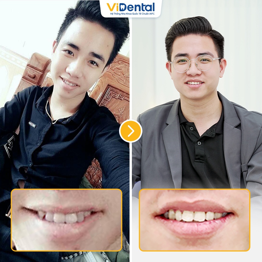 Hình ảnh của Công Hiển trước và sau khi niềng răng