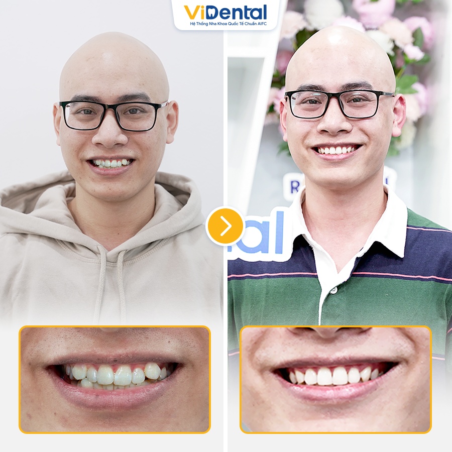 Hình ảnh của Duy Phong trước và sau khi niềng răng