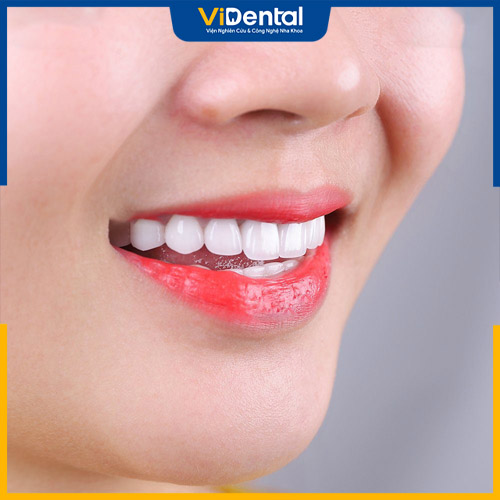 Răng sứ Emax được nhiều khách hàng lựa chọn