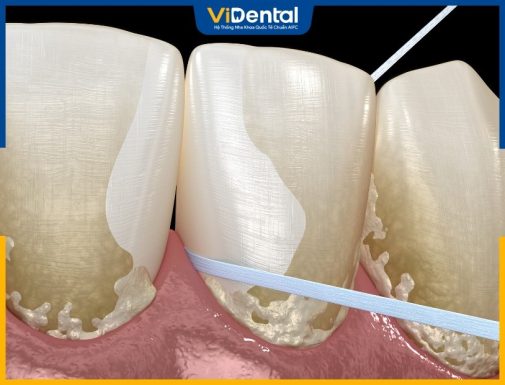 Bật Mí 7 Cách Làm Rụng Cao Răng Bảo Vệ Sức Khỏe Răng Phổ Biến