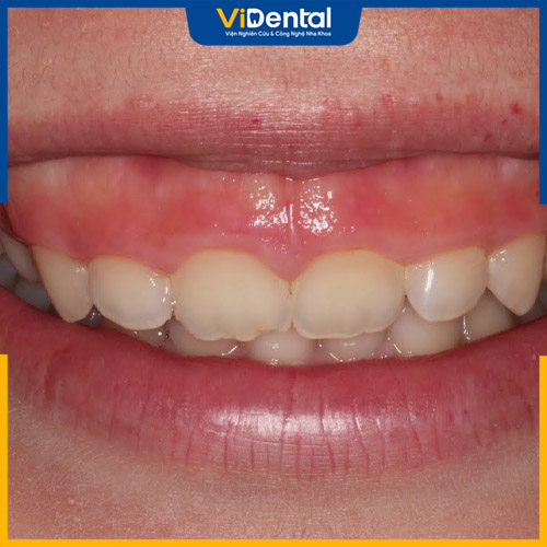 Răng có kích thước ngắn hơn bình thường sẽ gây hở lợi
