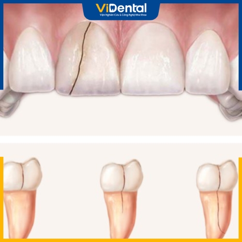 Gãy răng theo chiều dọc là tình trạng phổ biến