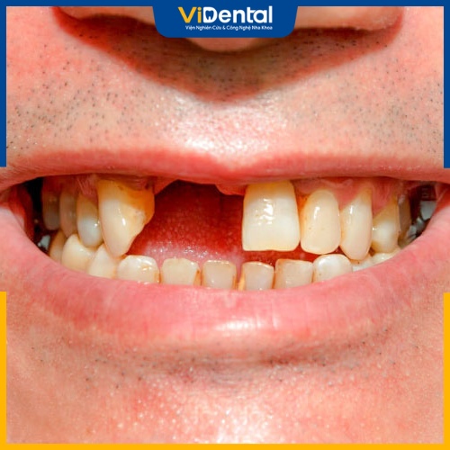 Răng bị gãy khiến chức năng ăn nhai bị ảnh hưởng 