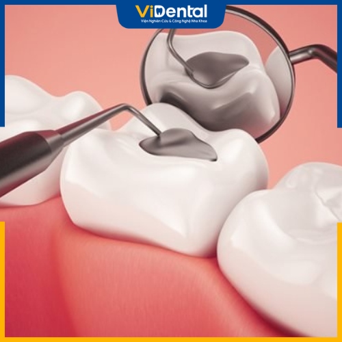 Trám răng giúp khắc phục tình trạng gãy răng mức độ nhẹ 