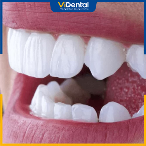 Có nhiều loại răng sứ khác nhau để bạn lựa chọn