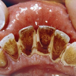 Mức độ tình trạng cao răng